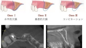 道歯学会一般口演河合20240809